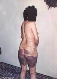 Das Foto zeigt eine Frau mit Bluterg�ssen
                          am halben K�rper, die im Iran Opfer einer
                          Auspeitschung mit 50 Peitschenhieben wurde.