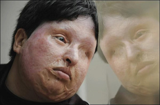 S�ureopfer Ameneh
                        Bahrami aus Teheran [27]. Weil ein islamischer
                        Mann in Teheran sich in sie verliebte, sie aber
                        nicht in ihn, sch�ttete er S�ure in ihr Gesicht.
                        Sie verlor das Gesicht und das Augenlicht