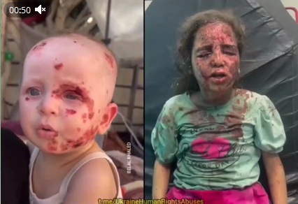 Gazastreifen-KZ am
                31.10.2023: Tausende Kinder sind durch die
                Bombardierungen schwer verletzt - hier 2 Beispiele: 1)
                das Baby am Kopf mit Splitterverletzungen, und 2) das
                M�dchen ist blind