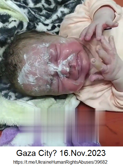 Gaza City-KZ? 16.11.2023: Die
                kriminelle Nazi-Zion-Armee hat einen Wonblock
                bombardiert - Baby hat Verbrennungen im Gesicht und
                Verletzungen durch Granatsplitter