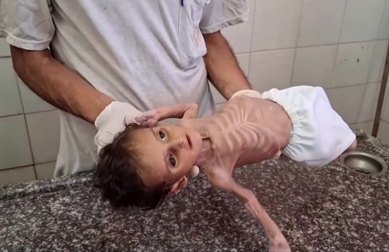 Killer-Israel spielt "Leningrad" am
5.7.2025 - 10:52h: Da sind total unterernährte Kinder,
z.B. Jouri Al-Masri, ca. 3 Jahre alt, nur noch Haut
und Knochen Killer-Israel spielt
"Leningrad" am 5.7.2025 - 10:52h: Da sind
total unterernährte Kinder, z.B. Jouri Al-Masri, ca. 3
Jahre alt, nur noch Haut und Knochen